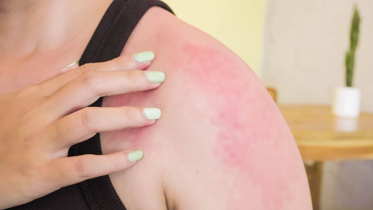 foto do ombro de uma menina com a pele queimada de sol